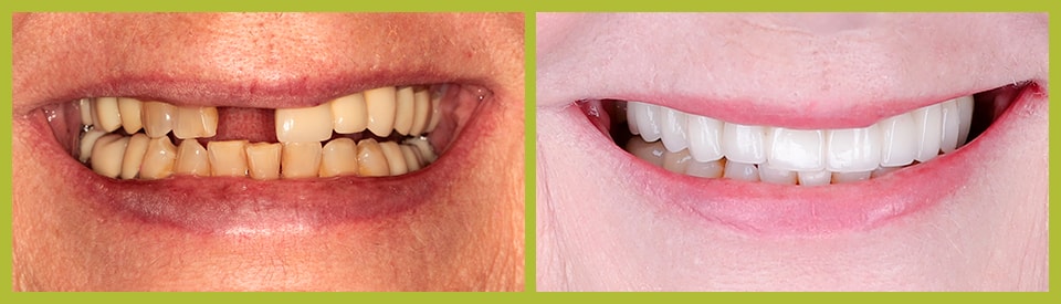 Image of an actual of porcelain veneers case from Serene Dentistry Actual Before and After of porcelain veneers case from our Smile Gallery