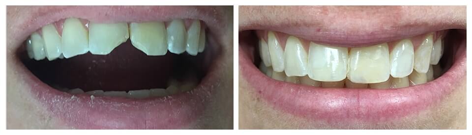 before and after fillings