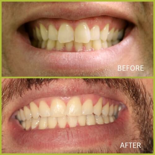 before and after Six Month Smiles
